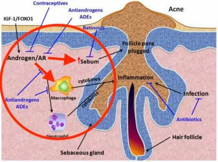 Acne formation diagram showing androgen receptor influence, inflammation process, and treatment interventions.