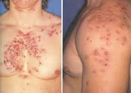 Red skin lesions on chest and shoulder, showcasing dermatological symptoms for sarms acne study.