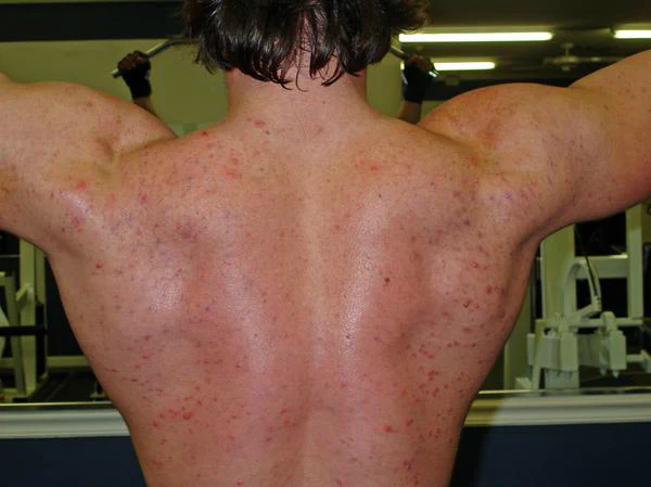 Back acne on muscular individual, highlighting sarms acne condition