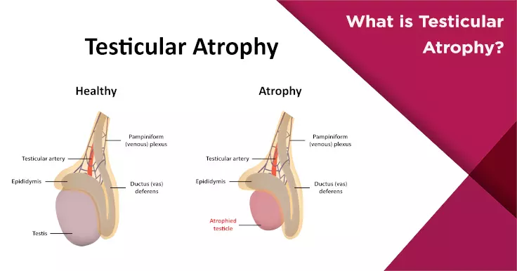 Comparison of healthy and SARMs-atrophied testicle anatomy showing changes in size and structure with labeled parts.