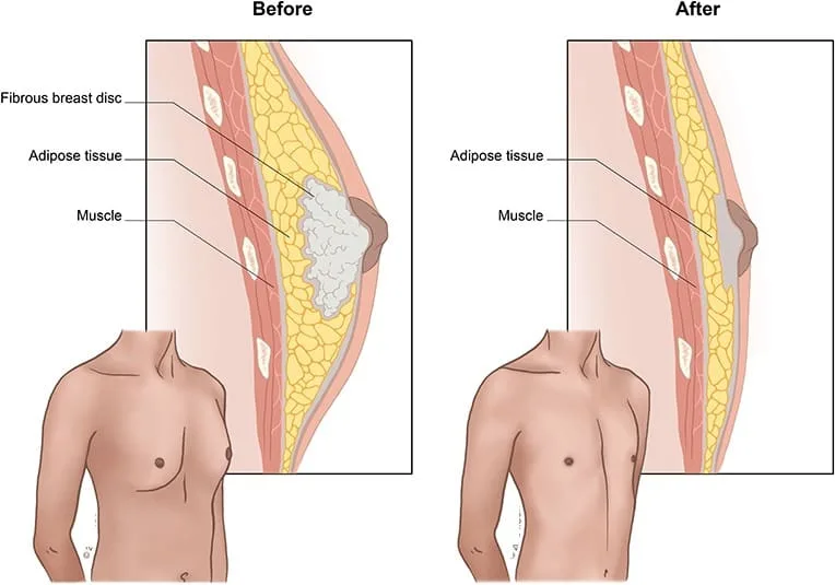 Diagram showing male breast tissue changes in gynecomastia caused by SARMs use and hormonal imbalance
