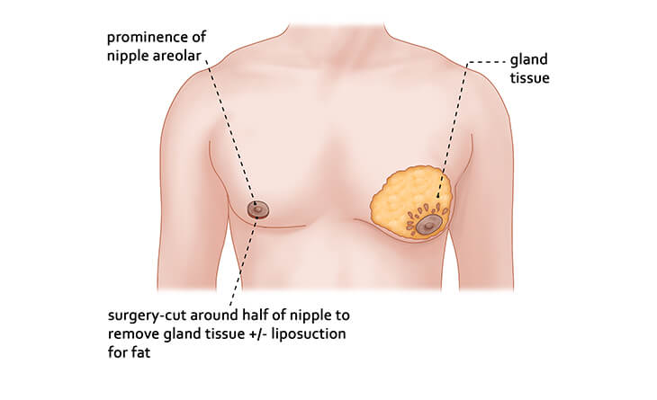 Can SARMs Cause Gynecomastia? 1 sarmsgyno